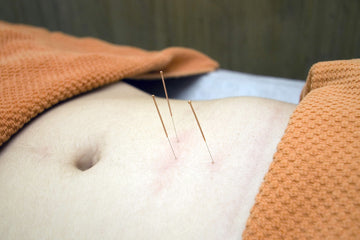 Acupuncture - Traditional Chinese Medicine